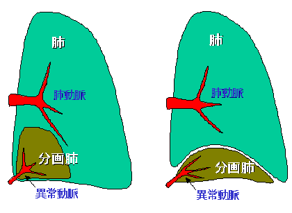 先天性の肺分画症と診断されて手術を迷ったときに