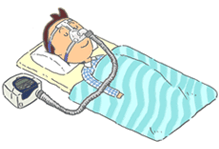 CPAP睡眠／睡眠時無呼吸症候群の検査結果とその後